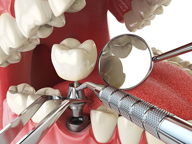 Best Emergency Root Canal Treatment in Ridgely, MD